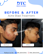 acne treatment by the best dermatologist