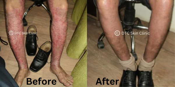 psoriasis treatment